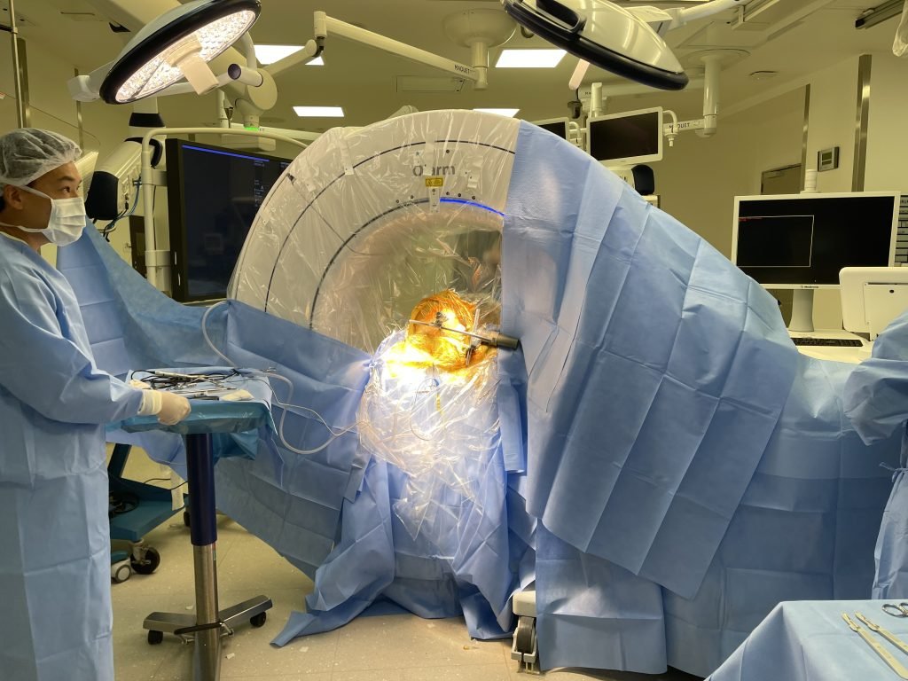 procedimento cirurgico de implante do DBS para o tratamento da Doença de Parkinson