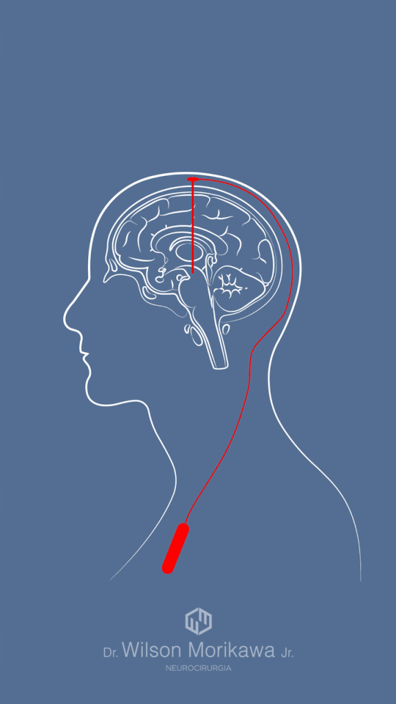 Como funciona a estimulação cerebral profunda