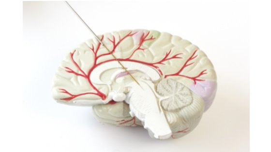Cirurgia de Parkinson é um procedimento que realiza o implante de um eletrodo de estimulação cerebral profundo (DBS). Dr Wilson Morikawa