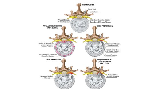 demonstra o que é a hérnia de disco e os tipos de hérnia